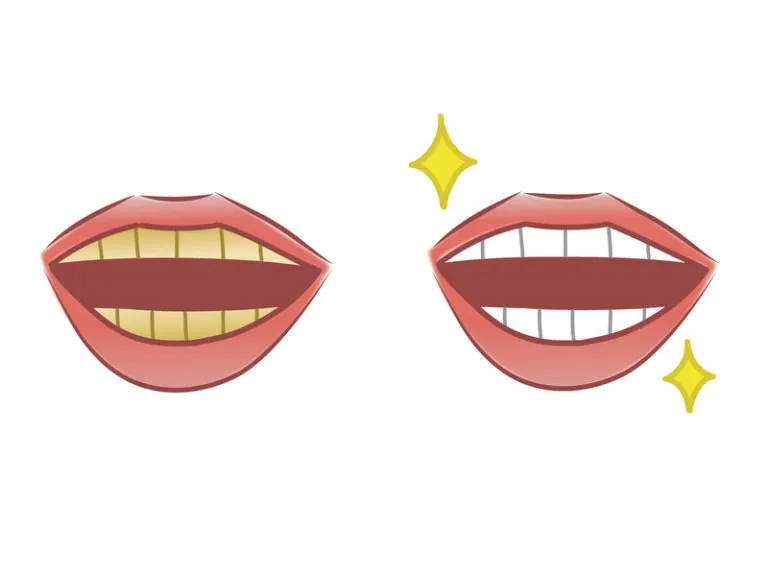 ホワイトニングの本数制限なし